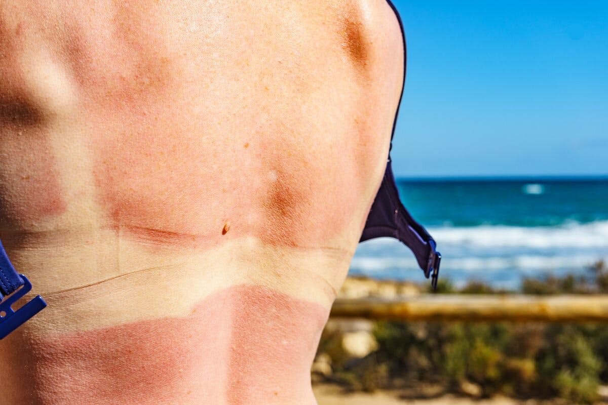 Verbrande huid door de zon: 5 tips en producten om jouw huid te verzorgen