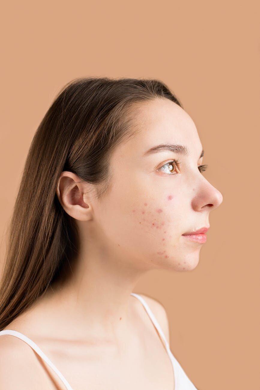 De beste skincare routine voor acne (per huidtype) volgens onze huidtherapeut