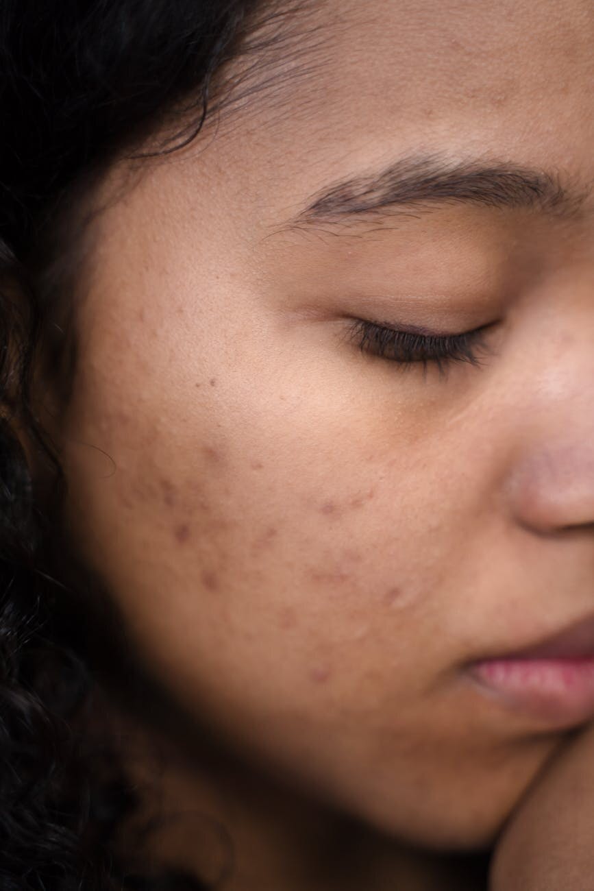 Post-acne littekens behandelen met producten volgens huidtherapeut