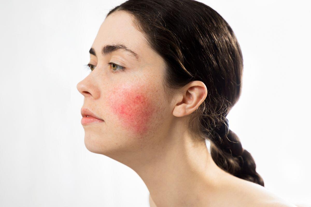 Deze ingrediënten kunnen je rosacea verergeren: zo vermijd je ze