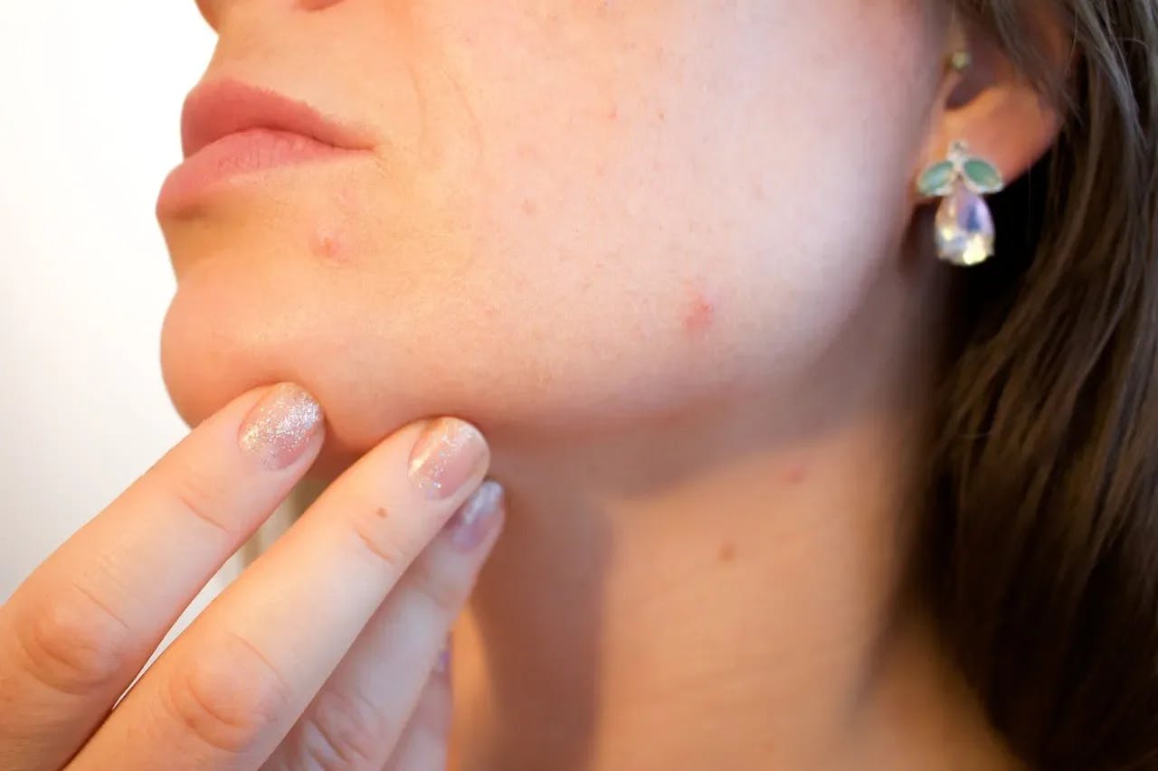Wat kun je doen tegen een vette huid?