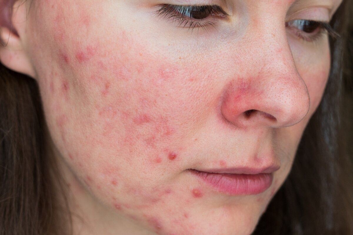 6 make-up tips voor rosacea van onze huidtherapeute