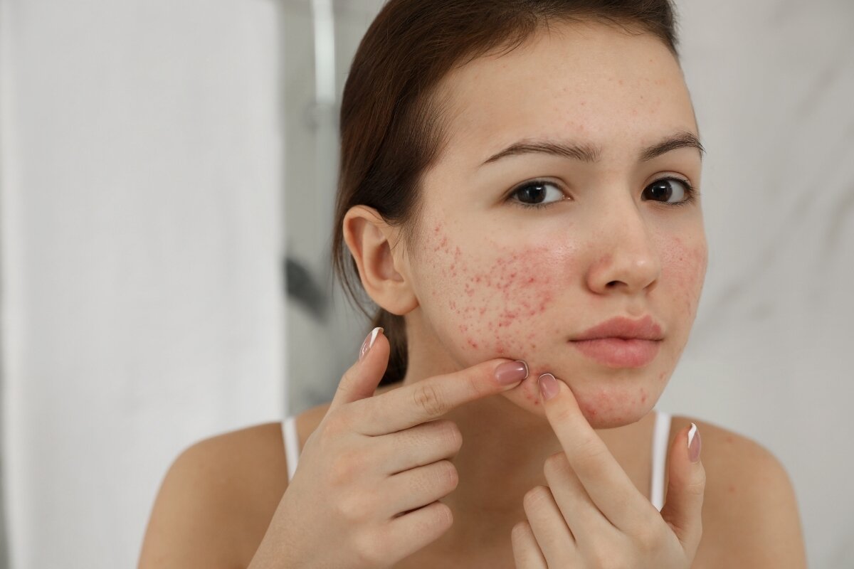 Acne aanpakken: dit werkt volgens onderzoek