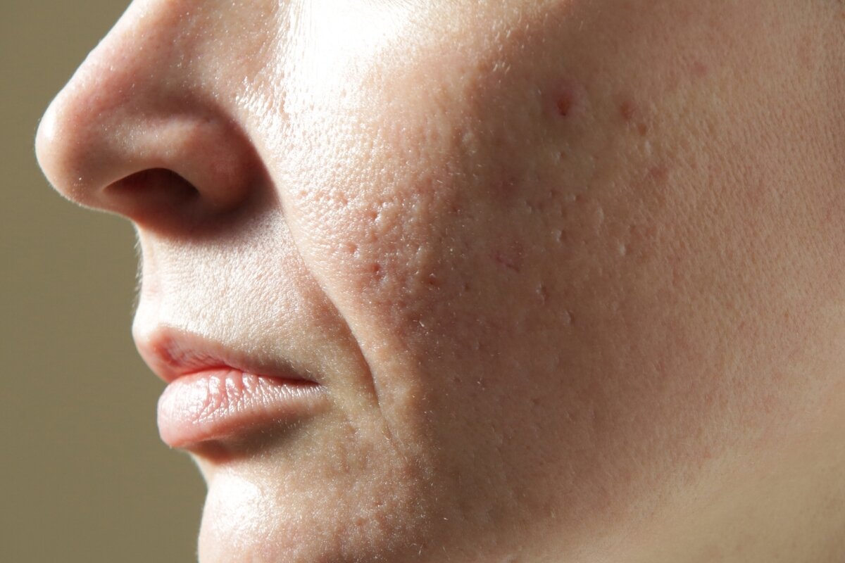 Wat betekent niet-comedogeen in skincare?