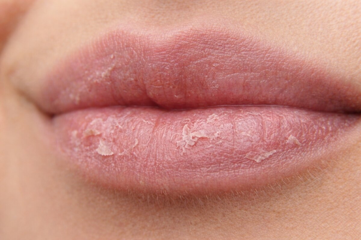 Droge lippen die steeds terugkomen? Dit kan je eraan doen