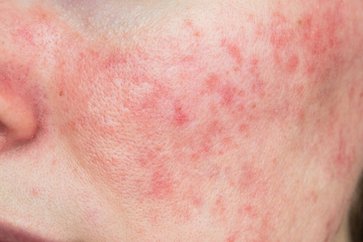 Deze triggers kunnen rosacea uitlokken of verergeren: zo vermijd je ze
