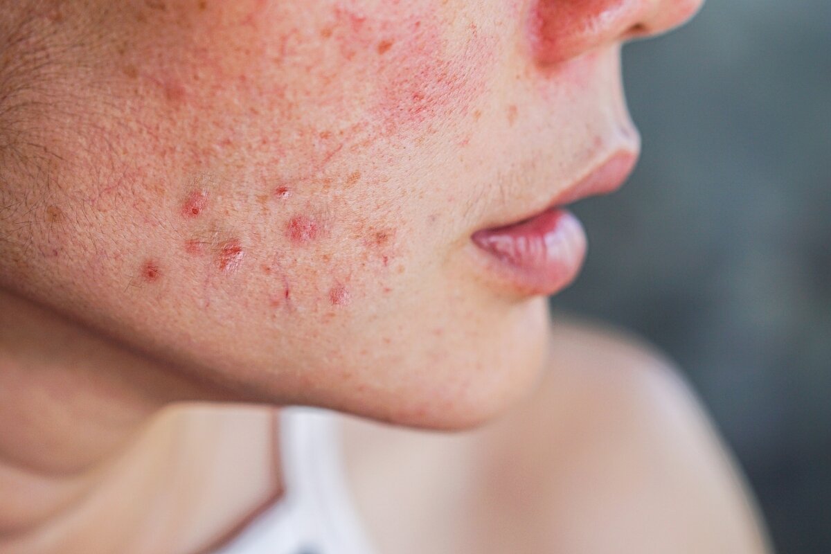 Deze ingrediënten zijn veilig bij het behandelen van acne 