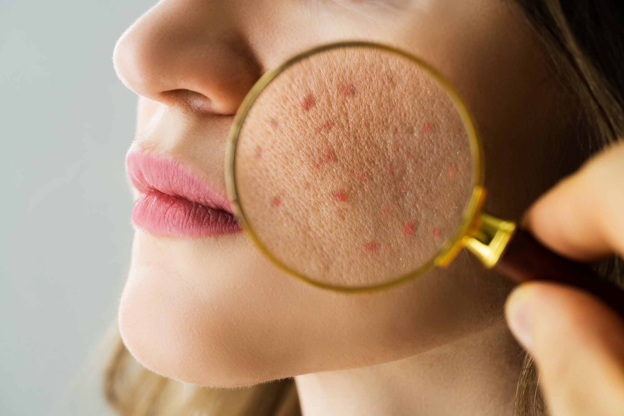 Geneest zon acne? En 6 andere feiten en fabel