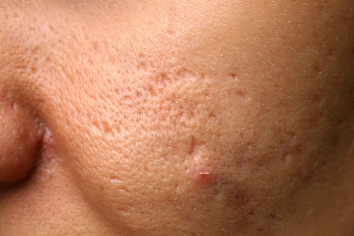 Acne littekens behandelen met producten volgens huidtherapeut