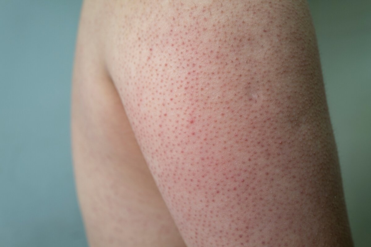 Keratosis Pilaris: Wat is het en hoe kun je het behandelen?