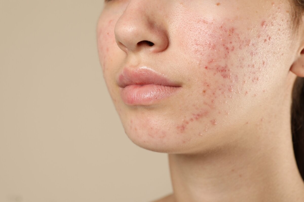 De beste skincare routine voor acne (per huidtype) volgens onze huidtherapeut