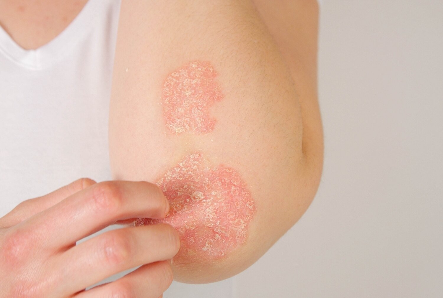 Psoriasis en huidverzorging: zo houd je je huid zo rustig mogelijk