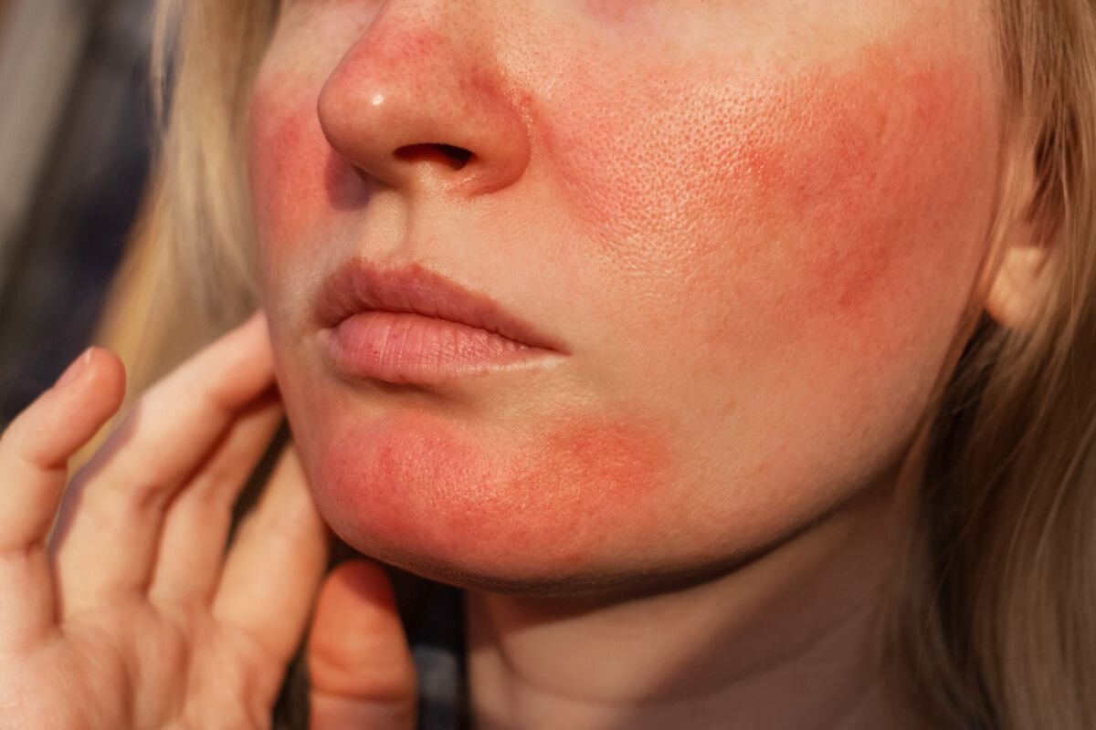  Rosacea opvlamming? Zo krijg je je huid weer rustig
