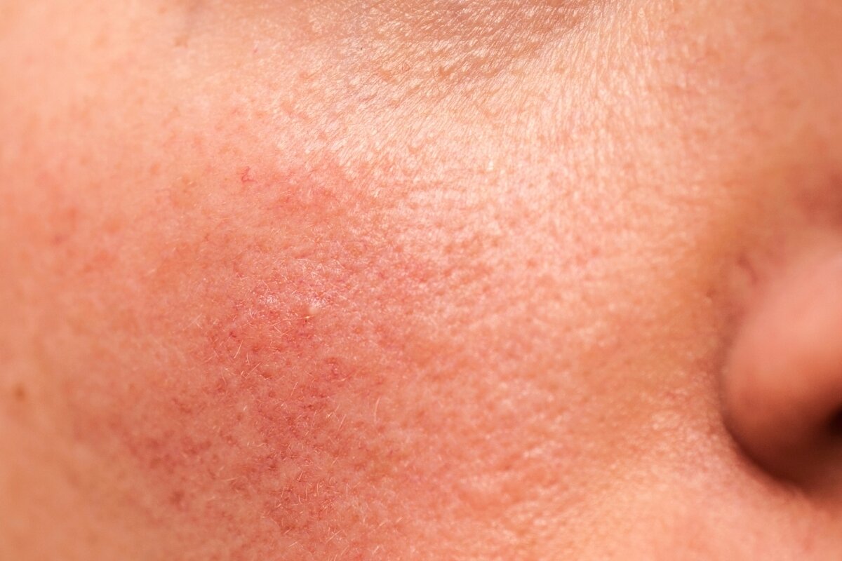 Deze ingrediënten kunnen je rosacea verergeren: zo vermijd je ze