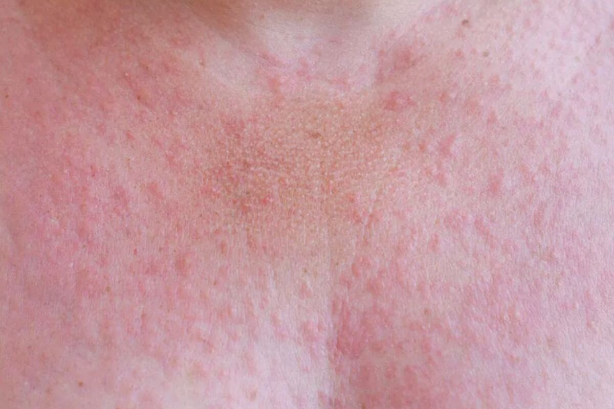 Zonneallergie: zo herken je het en zo verzorg je je huid na zon