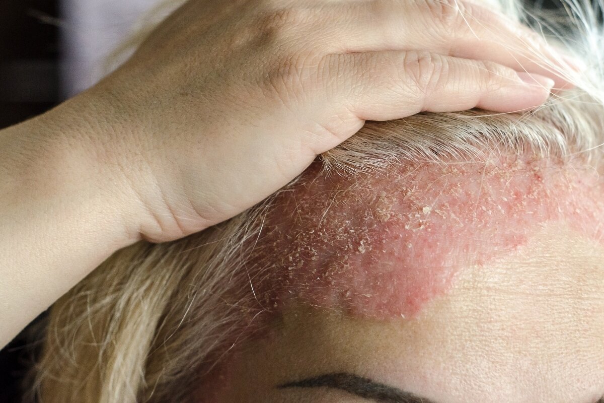 Eczeem en psoriasis, hoe kan ik dat het beste behandelen?