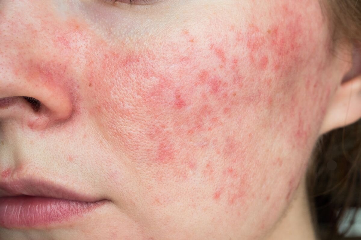Kan huidverzorging rosacea verminderen? 