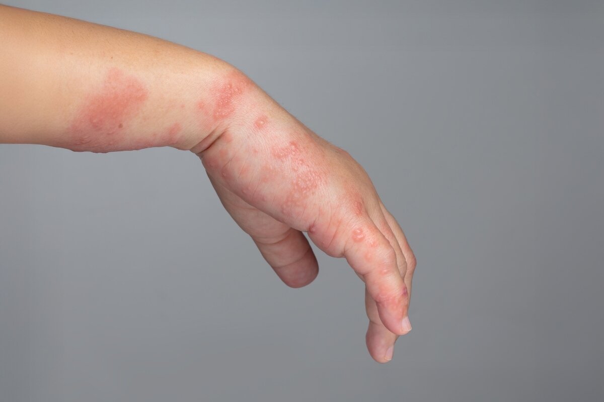 Huidallergie of irritatie? Zo herken je een contactallergie