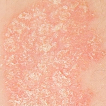Logo Psoriasis