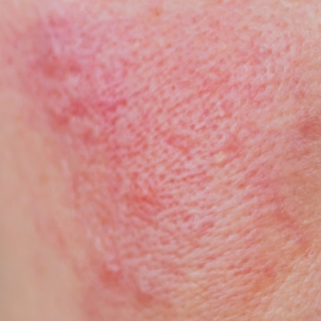 Logo Rosacea